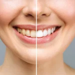 تبييض الأسنان في الشارقة الفرق بين أنواع التبييض وكيف تختار الأنسب لابتسامتك؟